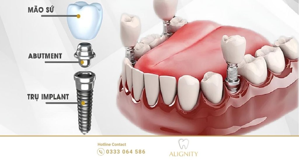 Cấu tạo hoàn chỉnh của răng Implant