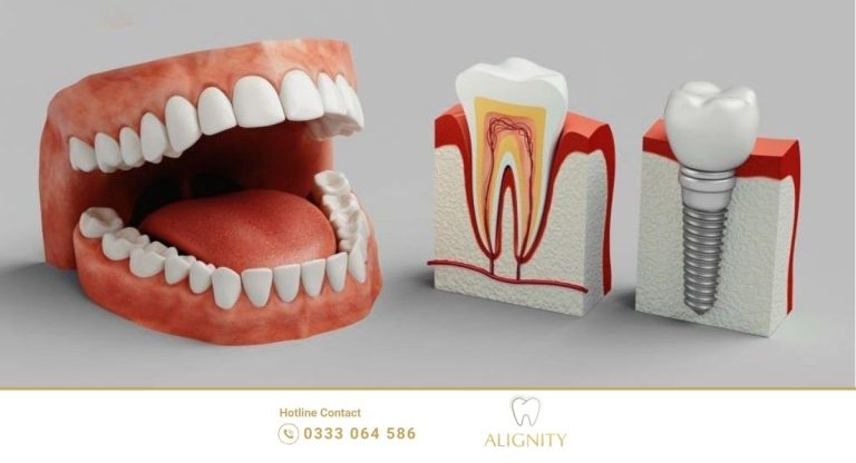 Trồng răng implant