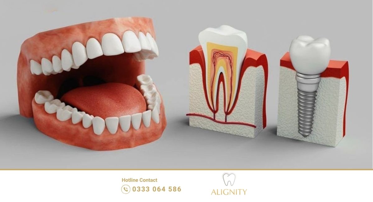 Trồng răng implant 