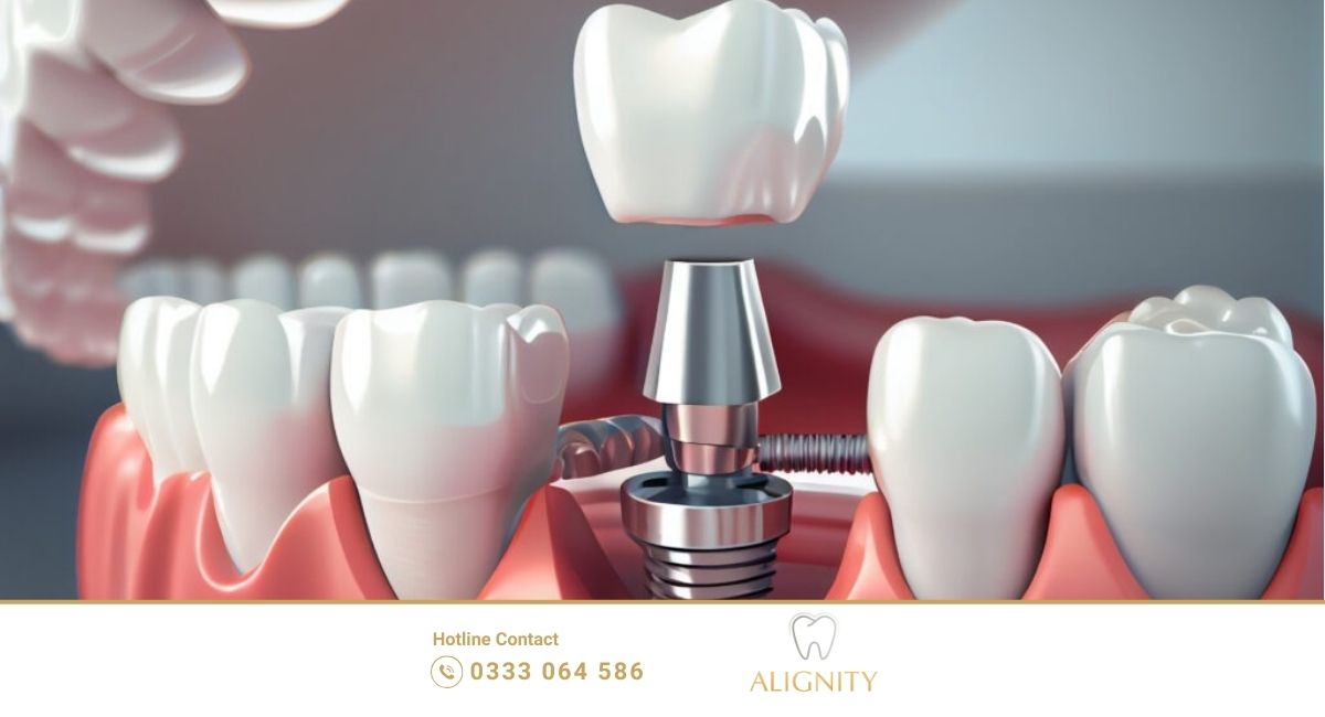 Ảnh đại diện trồng răng Implant