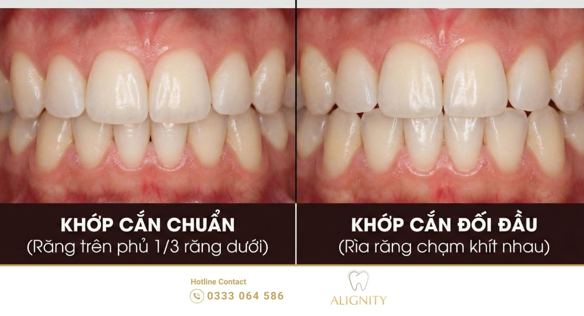 So sánh khớp cắn chuẩn và khớp cắn đối đầu - Nha khoa ALIGNITY.