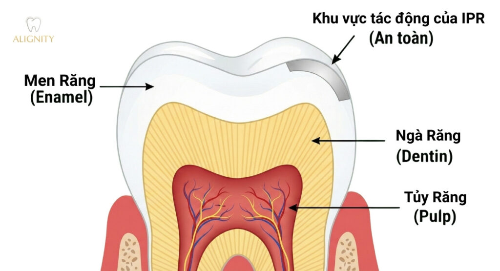 Mài kẽ răng (IPR) là gì? Góc nhìn chuyên sâu từ bác sĩ chỉnh nha 3 Cấu trúc giải phẫu răng và giới hạn an toàn khi mài kẽ.