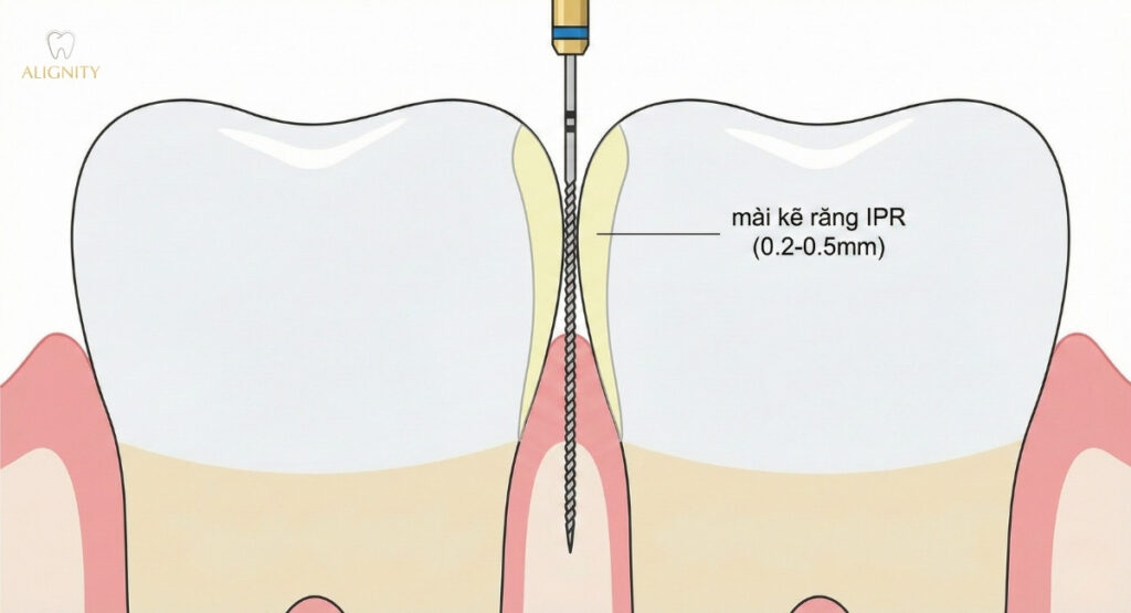 Mài kẽ răng (IPR) là gì? Góc nhìn chuyên sâu từ bác sĩ chỉnh nha 1 Mô phỏng kỹ thuật mài kẽ răng IPR tạo khoảng trống niềng răng.