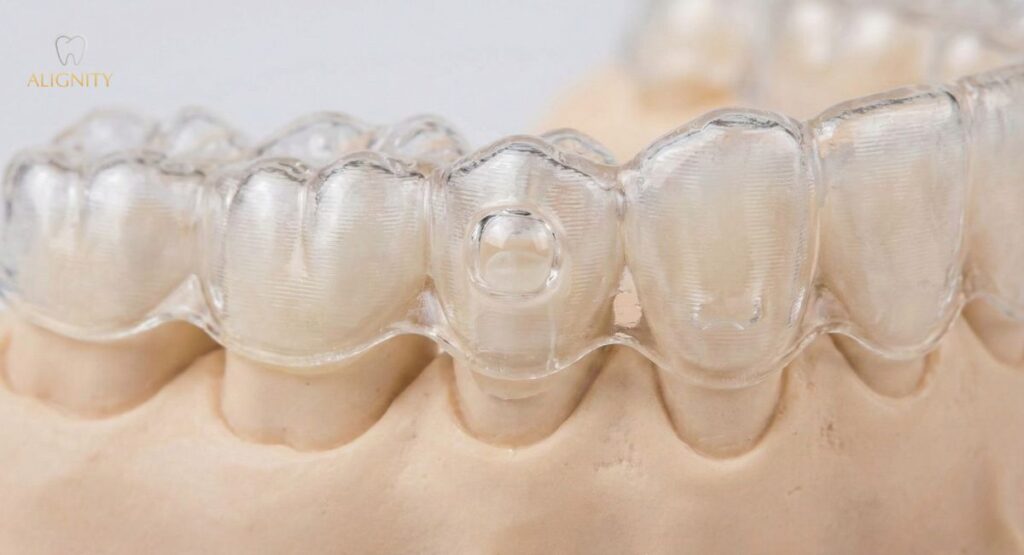 Khay niềng Invisalign có thiết kế lồi lõm tương thích với attachment