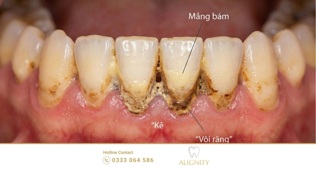 Cạo vôi răng: Lợi ích, quy trình và chi phí mới nhất 2026 2 Vôi răng không thể loại bỏ bằng cách đánh răng thông thường và cần sự can thiệp của nha sĩ chuyên khoa.