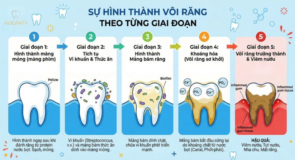 Cạo vôi răng: Lợi ích, quy trình và chi phí mới nhất 2026 1 Sự hình thành của vôi răng theo từng giai đoạn