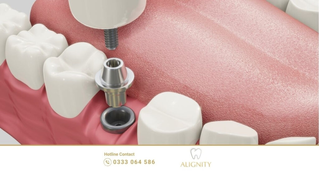 Scan 3D là bước khởi đầu quyết định sự thành công cho toàn bộ quy trình cấy ghép Implant