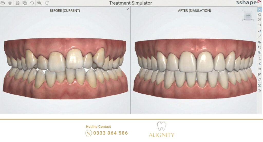 Phần mềm 3Shape TRIOS mô phỏng kết quả trước và sau khi niềng răng thẩm mỹ.