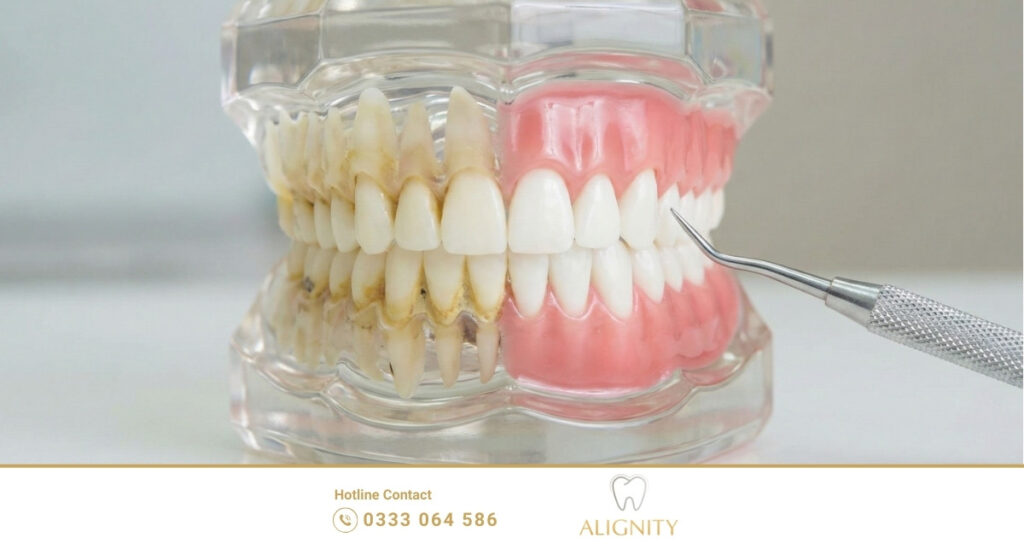 Khám răng định kỳ: lợi ích, quy trình và chi phí bạn cần biết 2 Hình ảnh so sánh răng bị đóng vôi và răng sạch bóng sau khi lấy cao răng
