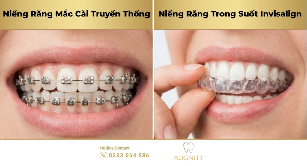 Khớp cắn chéo là gì? Dấu hiệu, nguyên nhân và cách khắc phục hiệu quả 2 khop can cheo 1