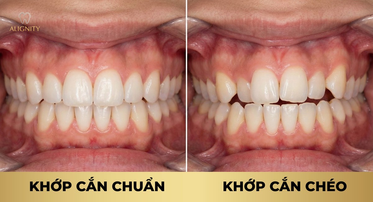 Khớp cắn chéo là tình trạng các nhóm răng mọc lệch lạc, gây mất cân đối giữa hai hàm.