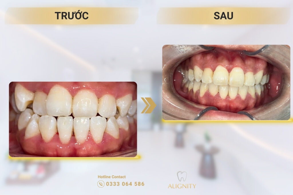 Khớp cắn chéo là gì? Dấu hiệu, nguyên nhân và cách khắc phục hiệu quả 6 Hình ảnh trước và sau khi điều trị khớp cắn chéo