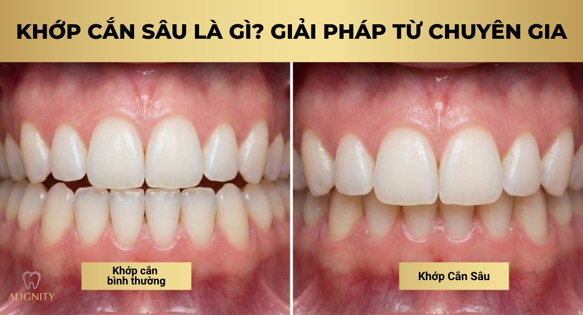 Khớp cắn sâu là gì? Giải pháp từ chuyên gia