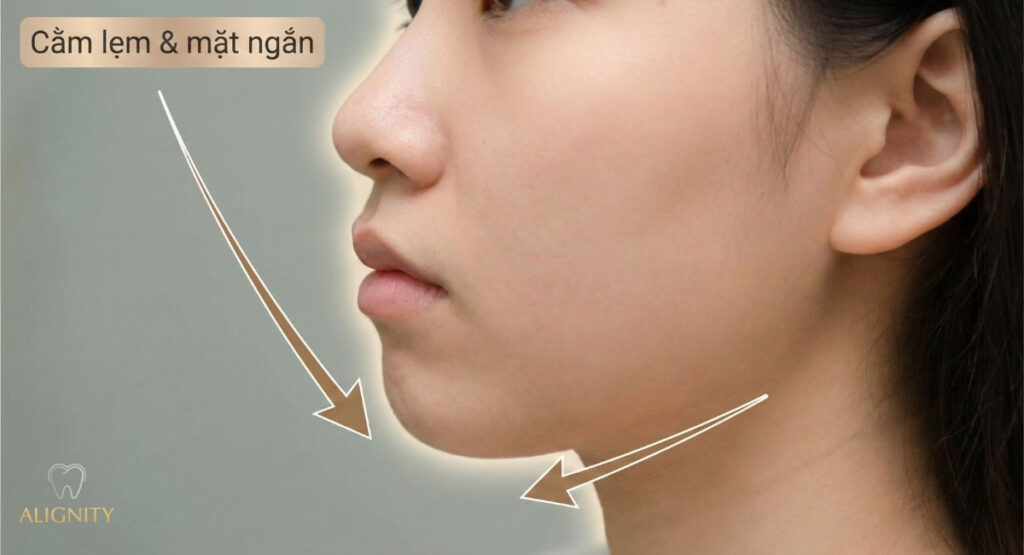 Góc nghiêng khuôn mặt của người bị khớp cắn sâu, cho thấy cằm lẹm và tầng mặt dưới ngắn.