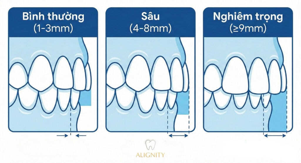 Phân loại ba mức độ khớp cắn sâu: bình thường, sâu và nghiêm trọng dựa trên tỷ lệ che phủ răng cửa.