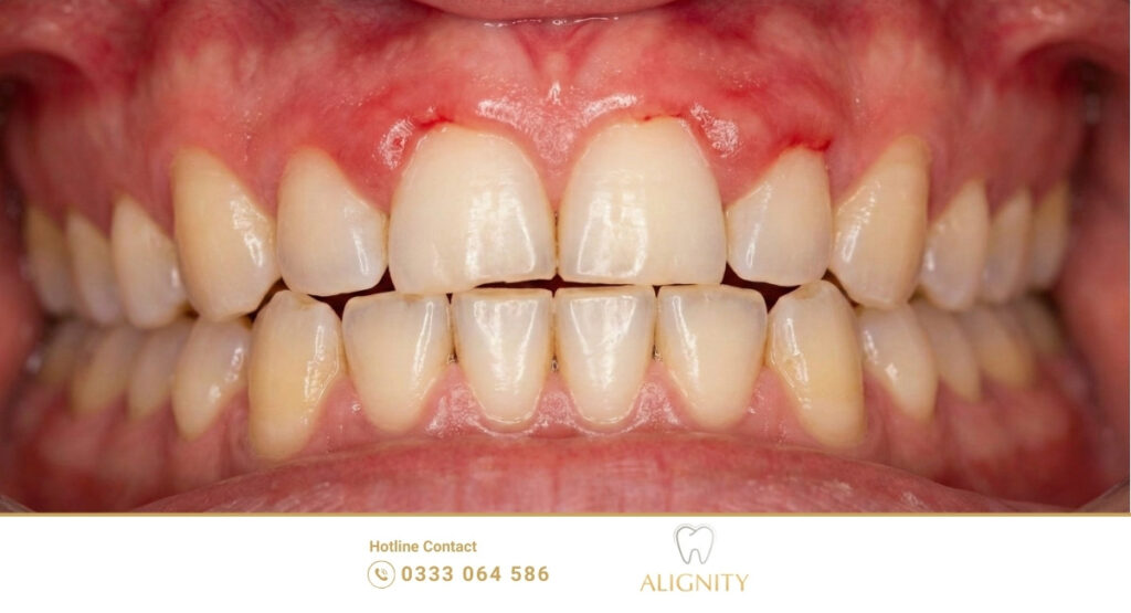 Tác hại của khớp cắn sâu: Nướu mặt trong hàm trên bị viêm đỏ do rìa răng hàm dưới chạm vào.
