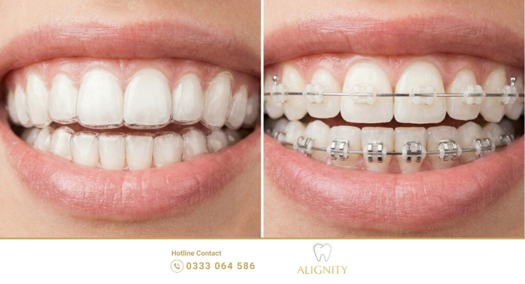 So sánh hai phương pháp niềng răng phổ biến cho khớp cắn sâu: Niềng răng trong suốt Invisalign và niềng răng mắc cài sứ.