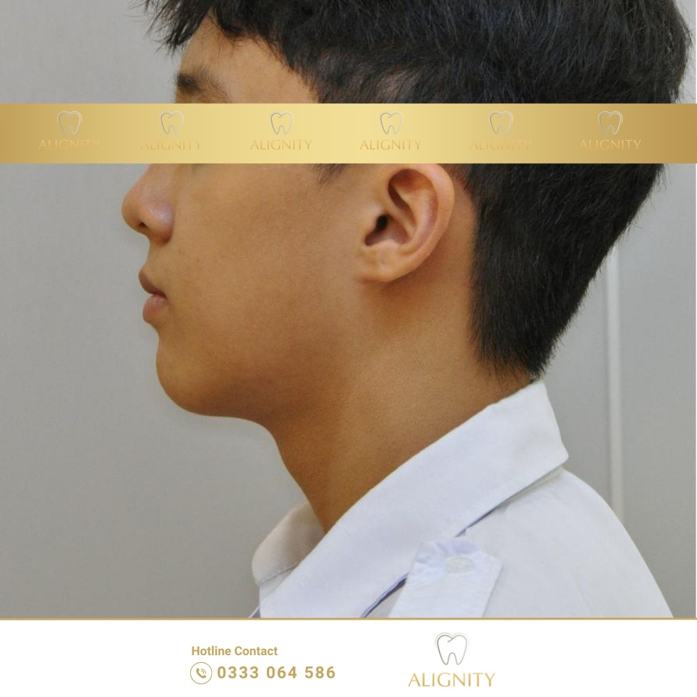 Hình ảnh sau khi điều trị  - Cung răng trở nên đều và tròn hơn, răng sắp xếp gọn gàng, góc nghiêng giảm hô rõ rệt