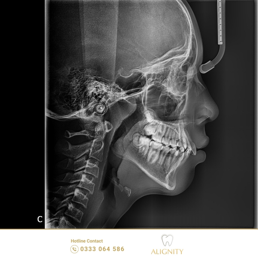 Hình chụp X-Quang bằng công nghệ CT Cone Beam 3D - Xác định được tình trạng hô răng và khớp cắn sâu