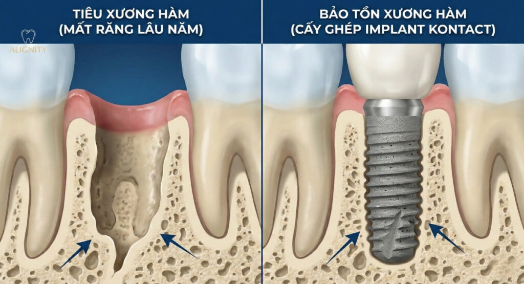 Trụ implant kontact: tìm hiểu xuất xứ, ưu điểm và bảng giá 2026 3 Trụ implant kontact truyền lực nhai trực tiếp xuống xương, giúp ngăn chặn triệt để tình trạng tiêu xương hàm.