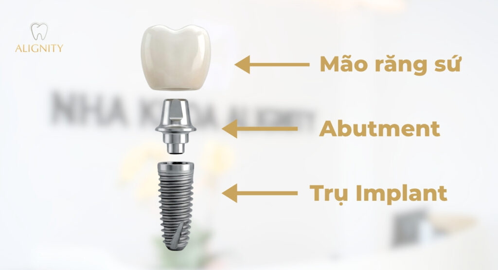 Cấu tạo răng Implant hoàn chỉnh gồm trụ Implant, Abutment và mão sứ.