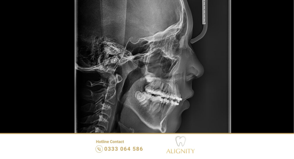 Hình chụp Xquang bằng công nghệ CBCT
