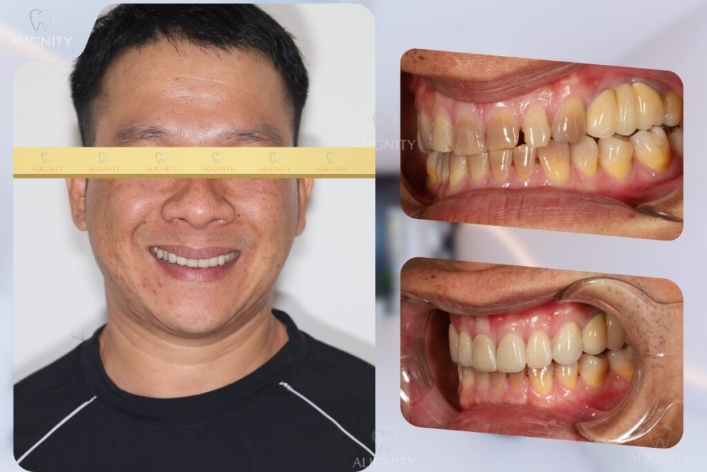 Trước và sau khi dán sứ Veneer
