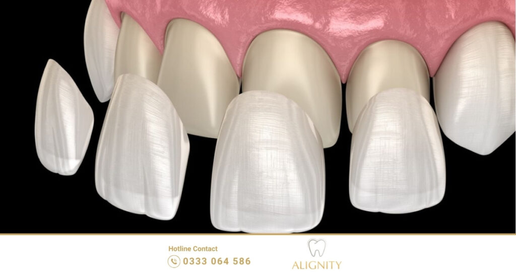 Hình ảnh inforgraphic quá trình dán sứ veneer