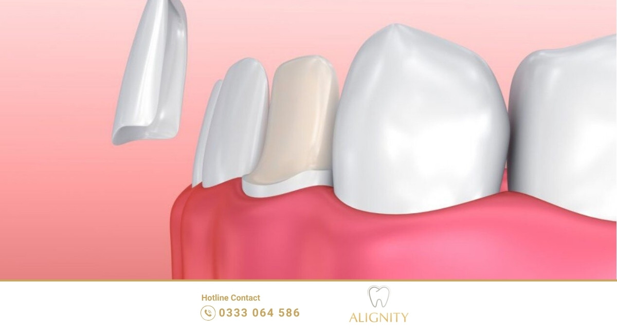 ảnh đại diện dán sứ veneer