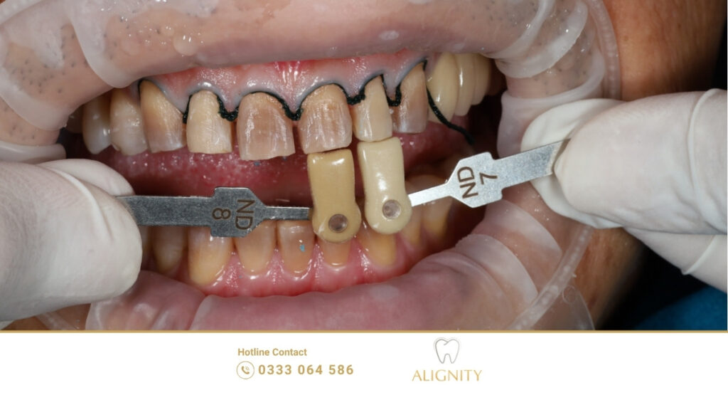 Các trường hợp nên và không nên thực hiện dán sứ Veneer