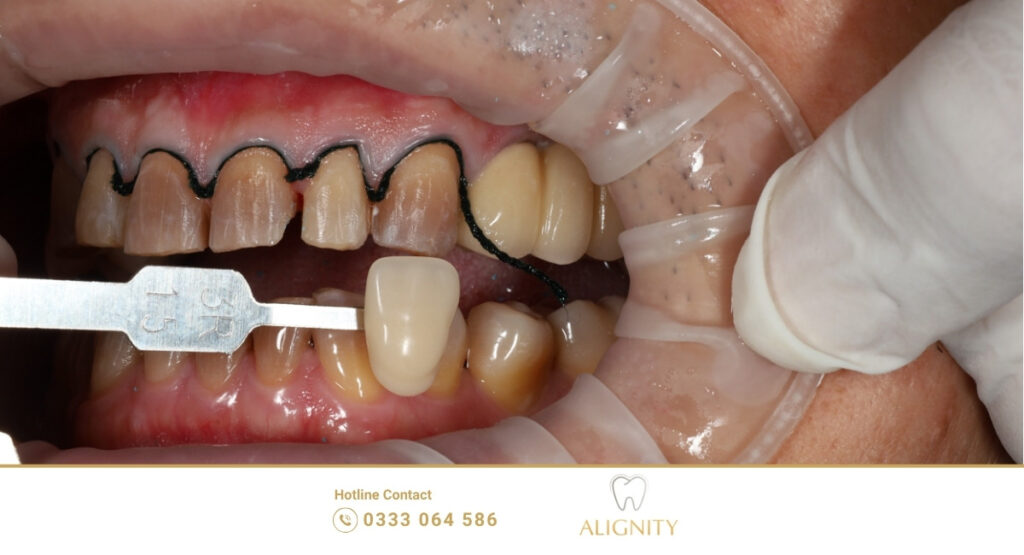 Dòng sứ Veneer E.max và Lisi cao cấp sử dụng tại ALIGNITY.