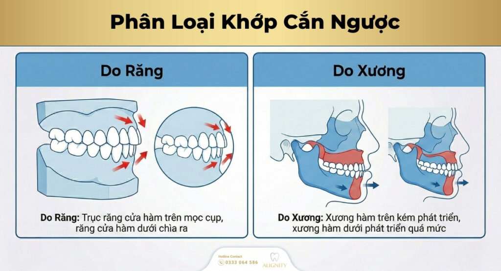 Phân loại các dạng khớp cắn ngược thường gặp