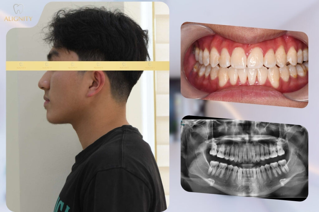 Khách hàng sau khi điều trị - răng đều hơn và gọn gàng, cải thiện rõ tình trạng móm 