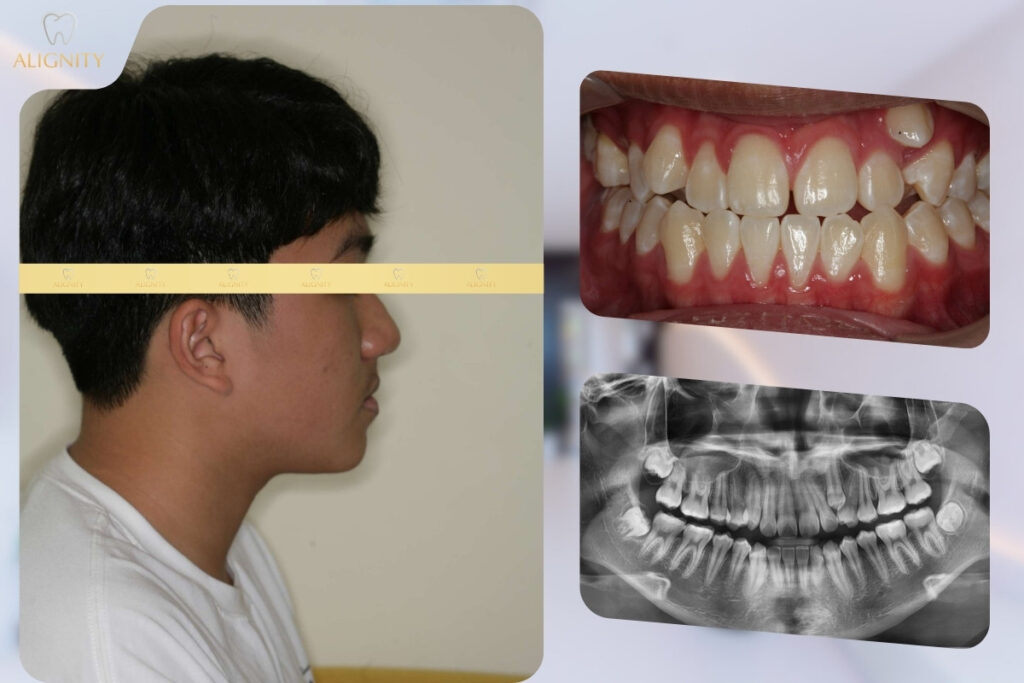 Tình trạng cung răng hàm trên chen chúc nặng, răng nanh (R23) nằm cao ngoài cung và đặc biệt là sai khớp cắn hạng III (móm nhẹ)