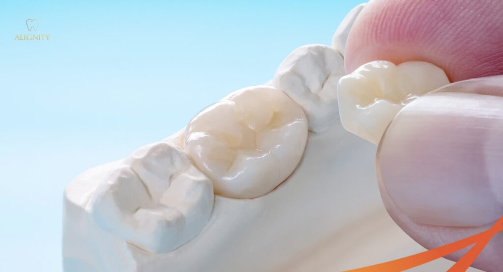 Hình ảnh mão sứ thẩm mỹ có hình dáng và màu sắc tương đồng với răng tự nhiên.