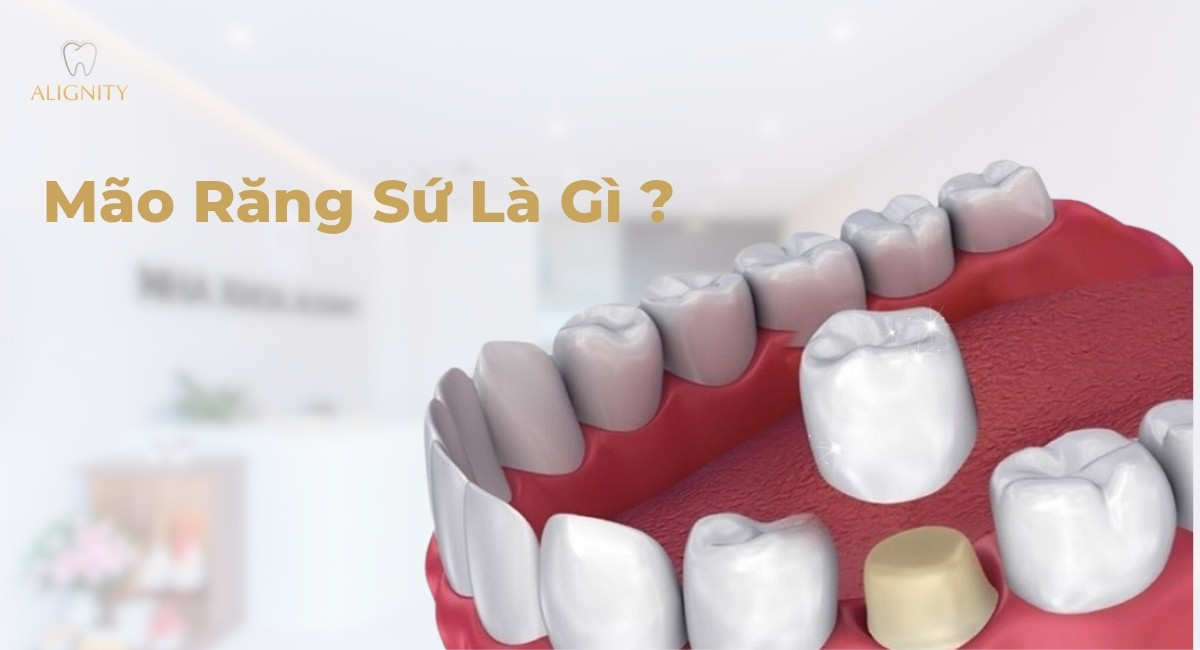 Hình ảnh đại diện bài viết Mão răng sứ là gì - Nha khoa ALIGNITY.