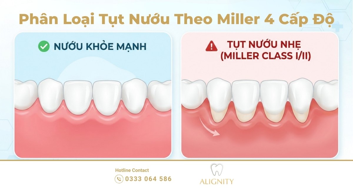 Hình ảnh minh họa so sánh nướu khỏe mạnh và răng bị tụt nướu theo phân loại Miller