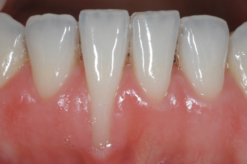 Phân loại Miller trong tụt nướu: Đánh giá và phác đồ điều trị chuyên sâu 3 Đánh giá và phân loại tụt nướu