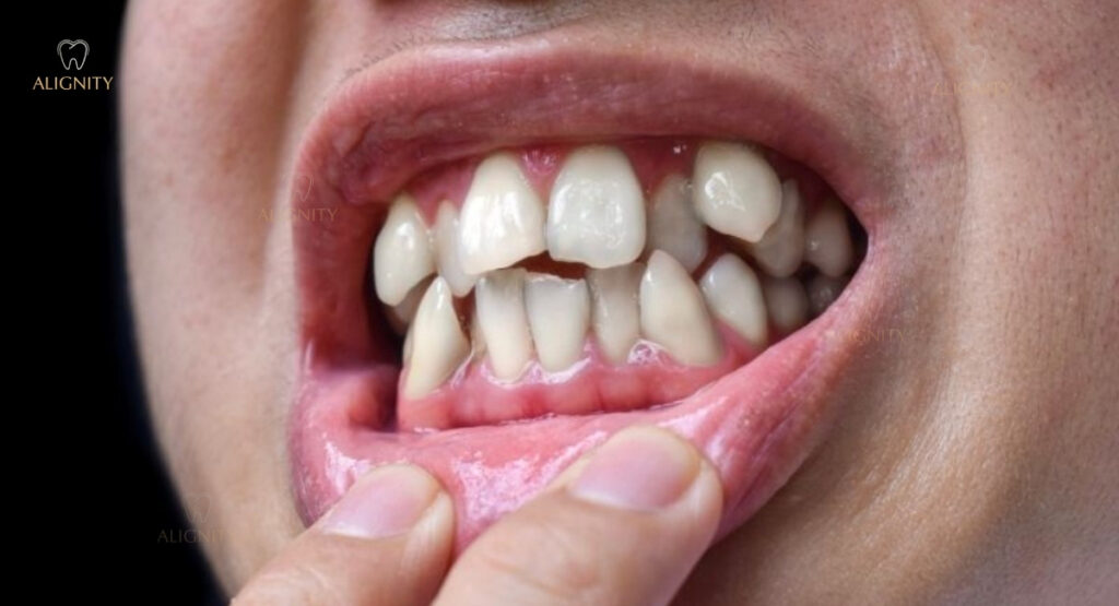 Hàm răng với các răng mọc chen chúc lẫn nhau 