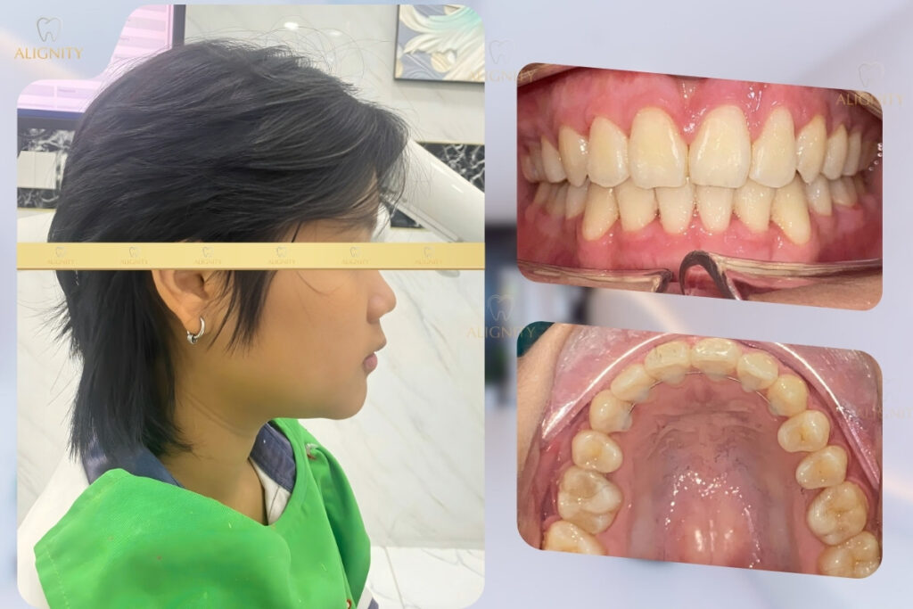 Hình ảnh sau khi điều trị răng mọc chen chúc tại ALIGNITY