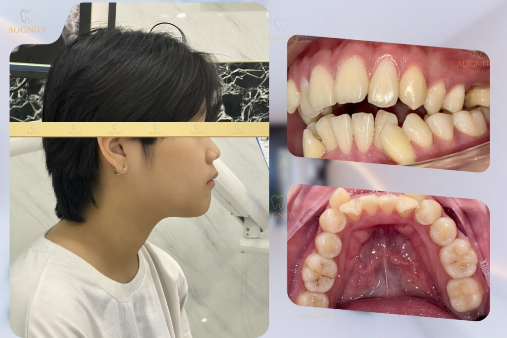 Hình ảnh trước khi điều trị răng mọc chen chúc tại ALIGNITY