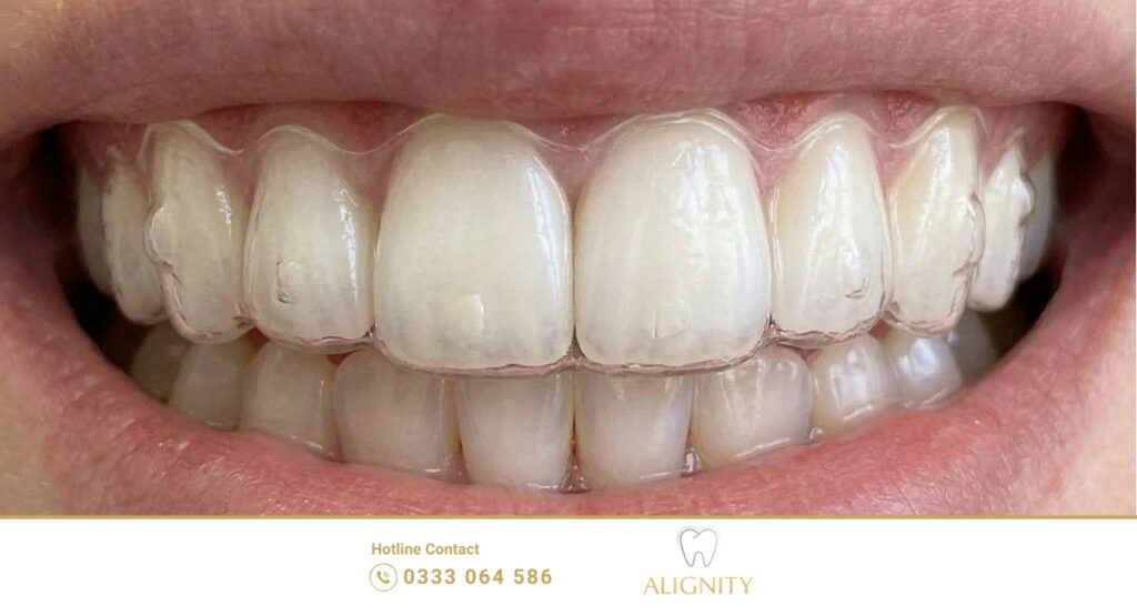 Bệnh nhân đang đeo khay niềng răng trong suốt Invisalign để chữa răng thưa toàn hàm.