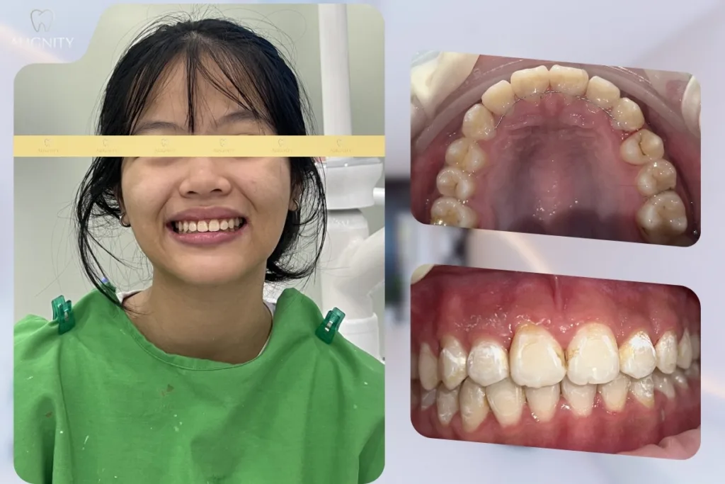 Hình ảnh sau khi niềng răng