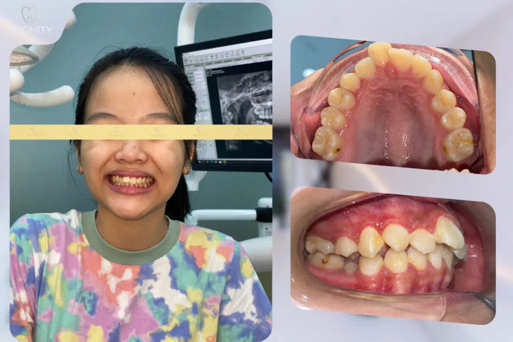 Hình ảnh trước khi niềng răng 