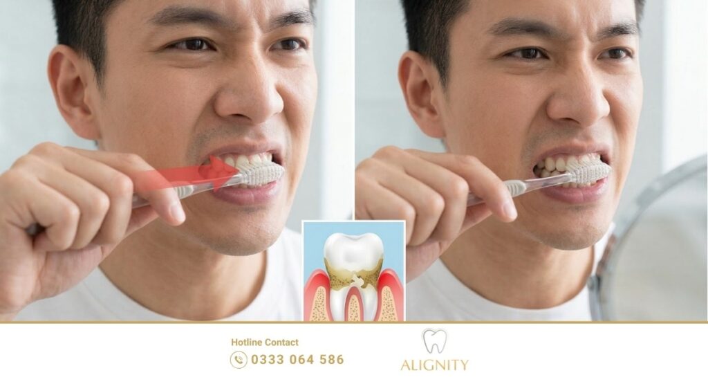Tụt lợi có tự khỏi không? Nguyên nhân và 4 cách khắc phục hiệu quả 3 Nguyên nhân gây tụt lợi hở chân răng