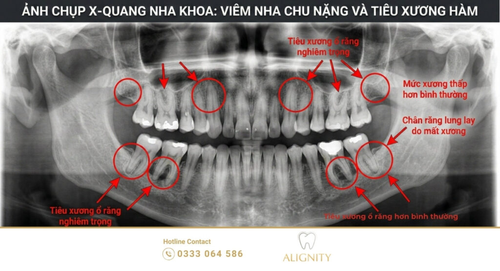 Ảnh chụp X-quang nha khoa thể hiện tình trạng tiêu xương hàm do viêm nha chu
