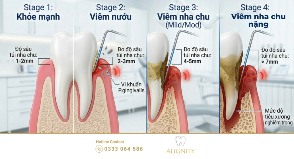 Sơ đồ đo độ sâu túi nha chu và mức độ tiêu xương ổ răng qua các giai đoạn bệnh lý nha chu.