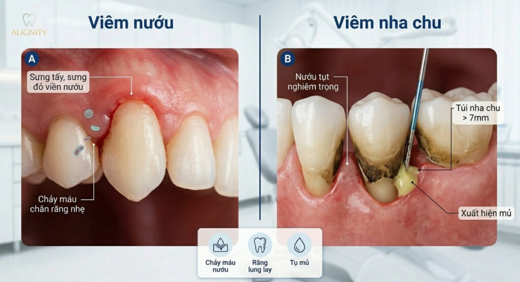 Chụp cận cảnh phân biệt nướu bị sưng đỏ chảy máu (viêm nướu) và nướu tụt lộ chân răng có mủ (viêm nha chu).