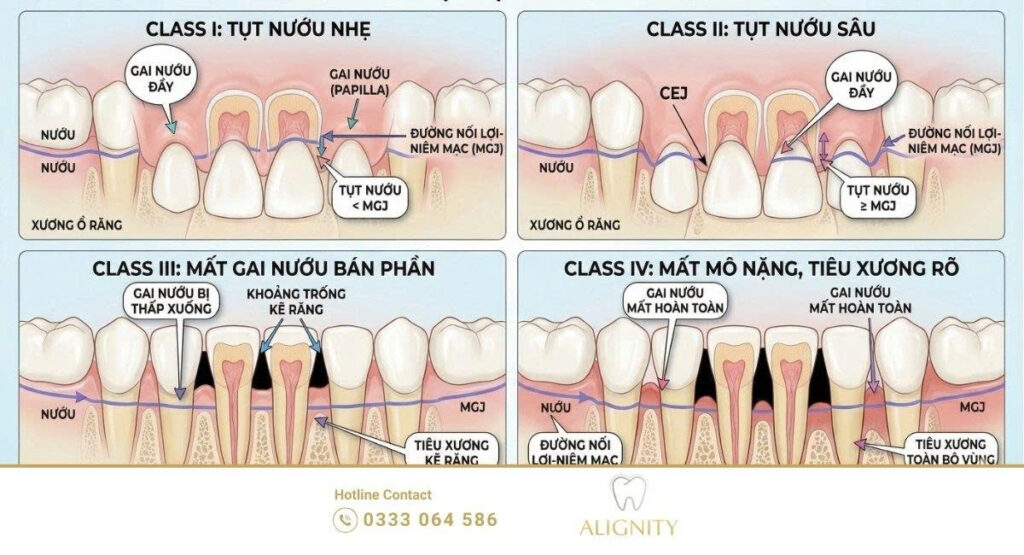 Phân loại Miller trong tụt nướu: Đánh giá và phác đồ điều trị chuyên sâu 2 Chi tiết 4 cấp độ tụt nướu theo hệ thống Miller