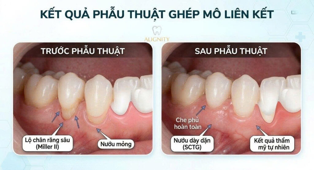 Phân loại Miller trong tụt nướu: Đánh giá và phác đồ điều trị chuyên sâu 4 Hình ảnh so sánh trước và sau khi ghép mô liên kết
